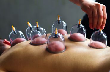 Cupping Therapy